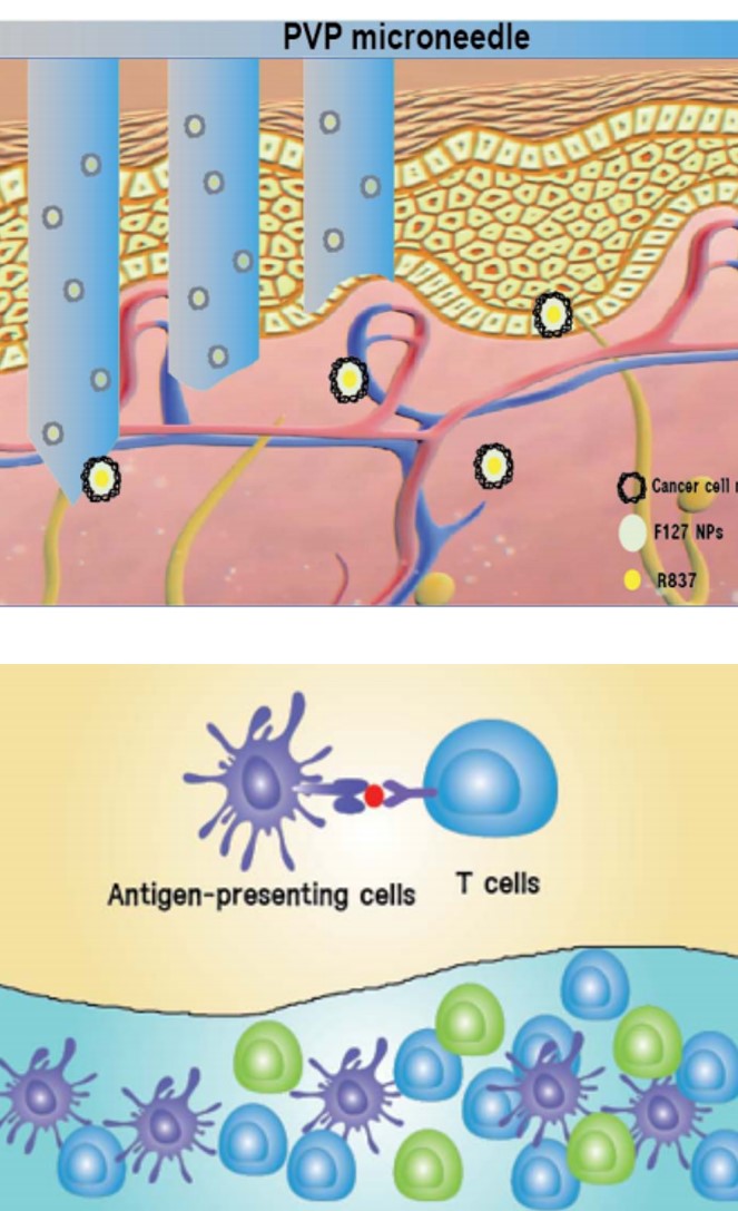 [고분자약물전달실험실] 암 면역치료를 위한 나노입자 코팅 마이크로니들 개발